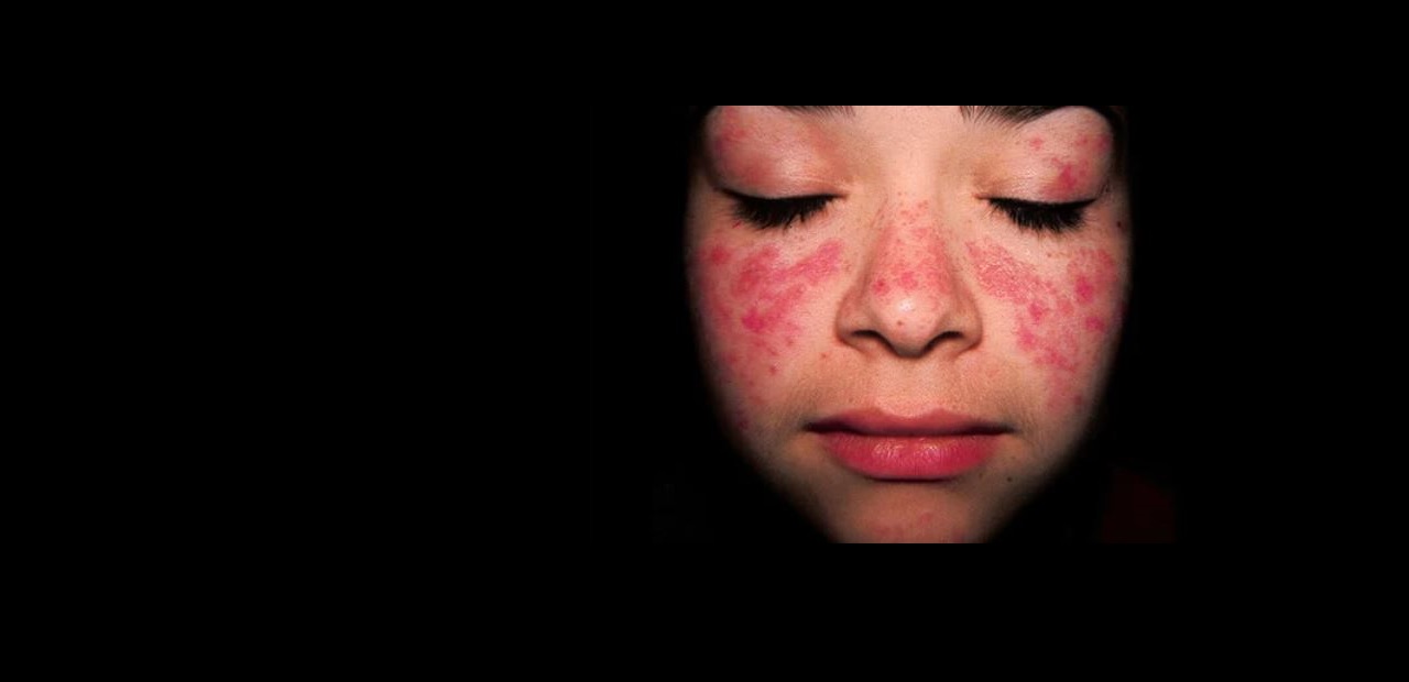 Giornata Mondiale del Lupus, continua l’impegno della Lupus Clinic dell’ASST Gaetano Pini-CTO