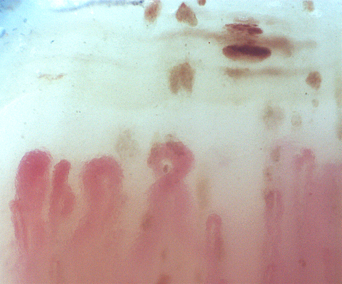 Giornata mondiale Sclerodermia