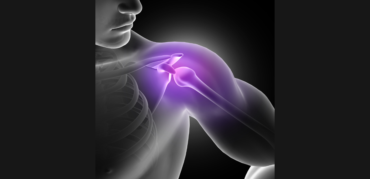 Frattura omero, nel 20% dei casi trattata con fissatori esterni