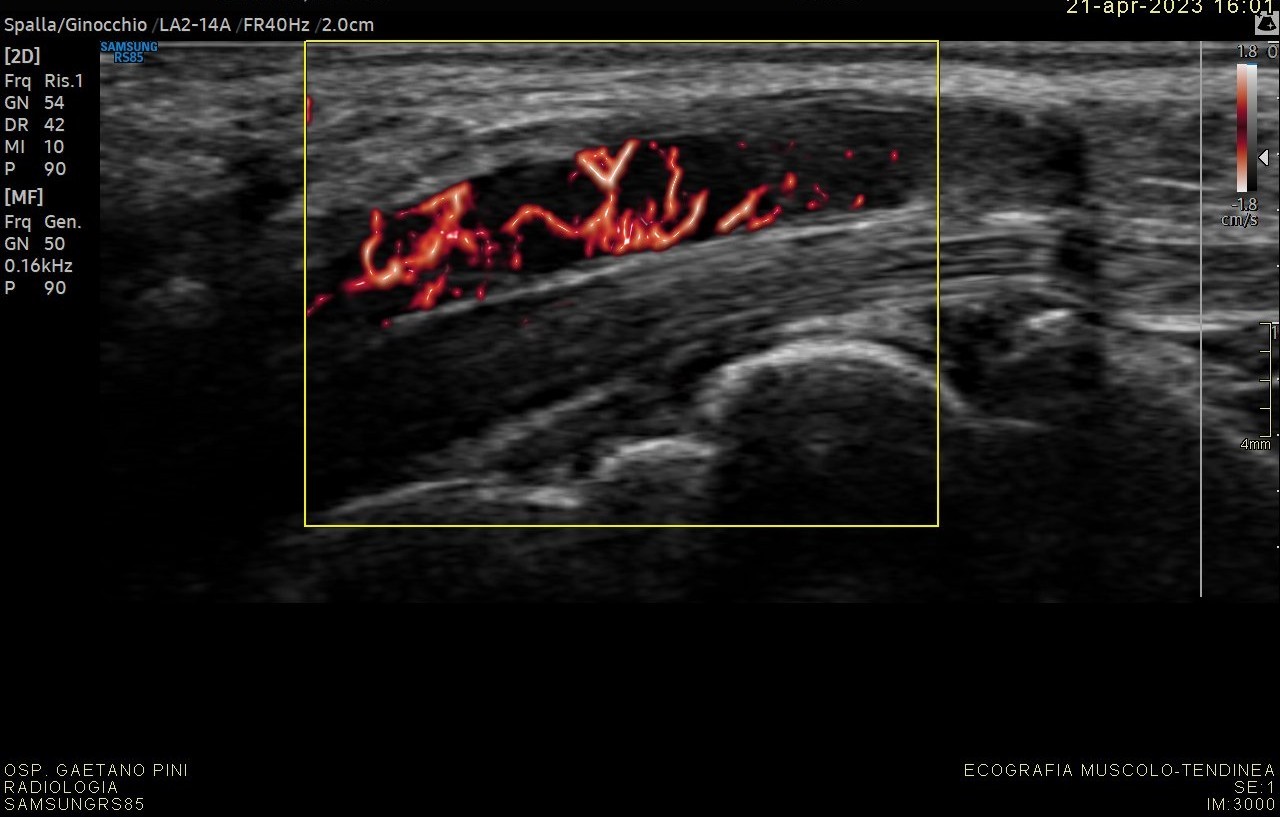 Chirurgia della mano, migliori risultati grazie all’uso dell’ecografia